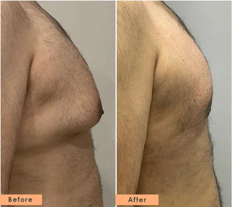 Gynecomastia in jaipur