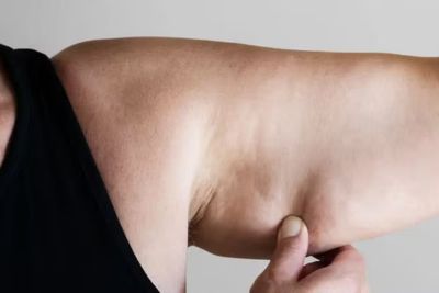 Arms and back liposuction treatment area