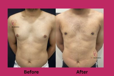 Best gynecomastia treatment in Jaipur before and after photo