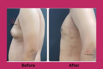 Gynecomastia treatment in Jaipur patient before and after results