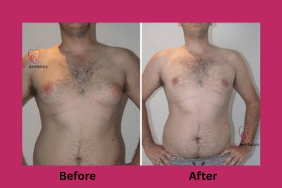 Male chest contouring surgery outcome in Jaipur