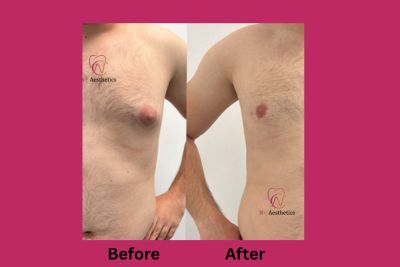 Gynecomastia treatment before and after images by Dr. Vikas Gupta
