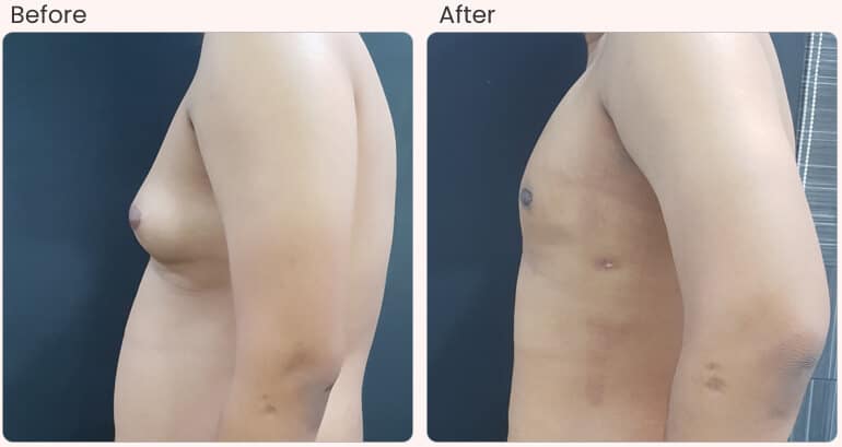 Gynecomastia in jaipur