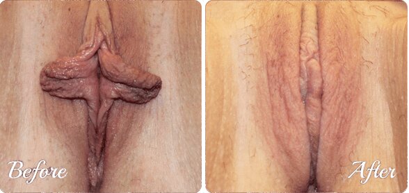 Vaginoplasty in Jaipur