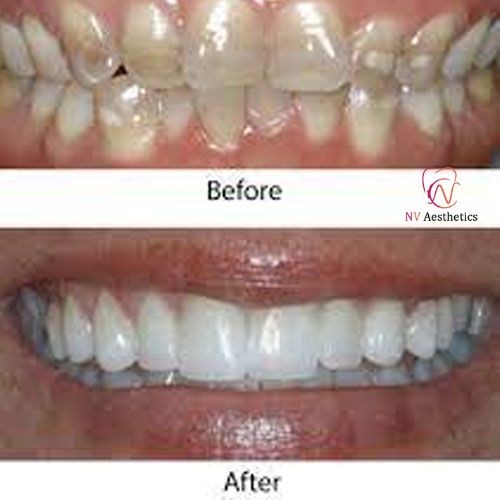 Dental Treatment Before and After Result