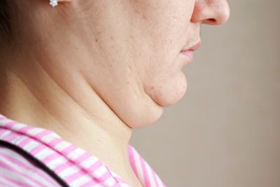 Chin liposuction treatment area