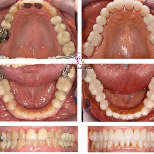 Cosmetic Dentistry Before and After Result