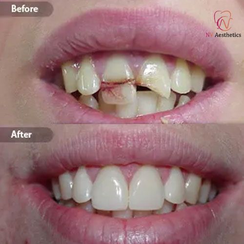 Cosmetic Dentistry Before and After Result