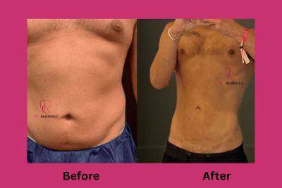 Liposuction before and after result, waist