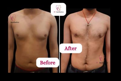grade2 gynecomastia patient before and after
