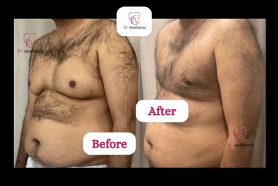 grade4 gynecomastia patient before and after