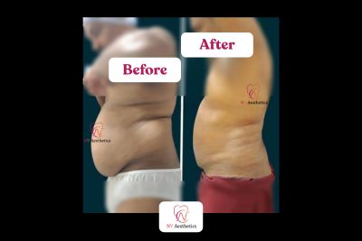 High definition liposuction before and after, abdomen case 1