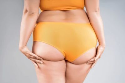 Thighs liposuction treatment area
