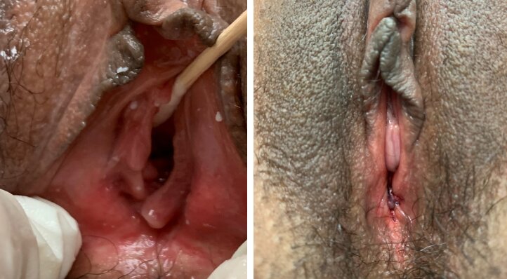 Hymenoplasty Treatment in jaipur