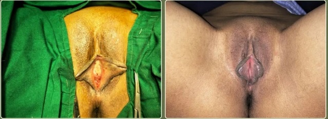 Hymenoplasty Treatment in jaipur