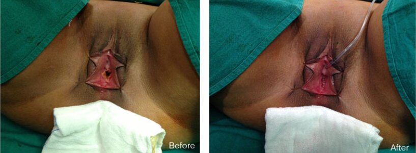 Hymenoplasty Treatment in jaipur