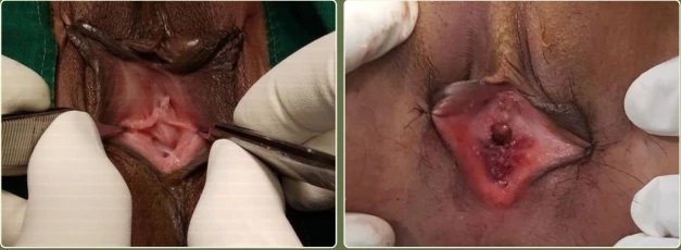 Hymenoplasty Treatment in jaipur