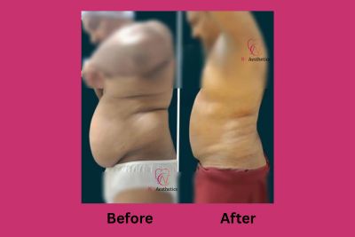 Liposuction before and after result, waist