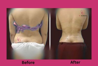 Liposuction before and after result, waist