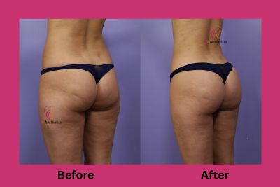 Liposuction before and after result, thighs