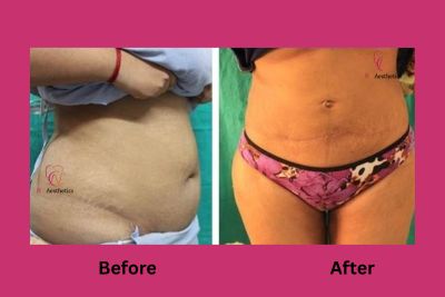 Liposuction before and after result, waist