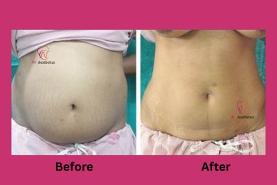 Liposuction before and after result, abdomen