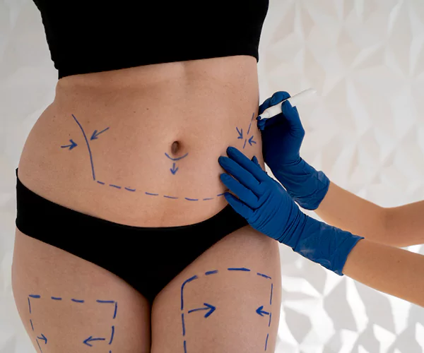 Doctor consulting a patient before liposuction treatment in Jaipur