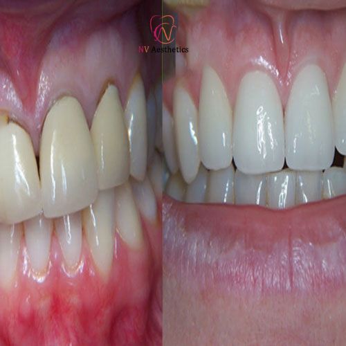 Smile Transformation Before and After Result