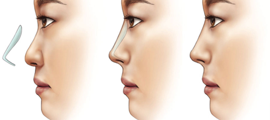 Rhinoplasty Treatment in Jaipur