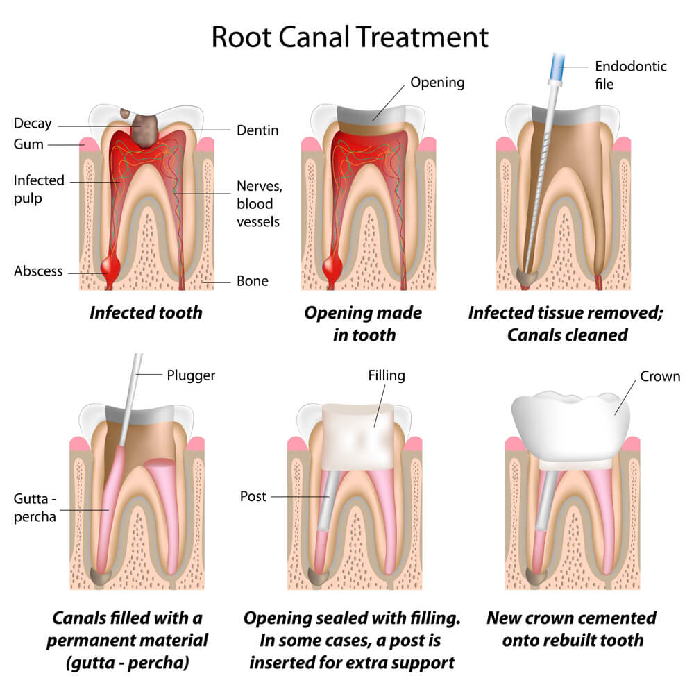 RCT Procedure 
