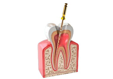 Root Canal Treatment