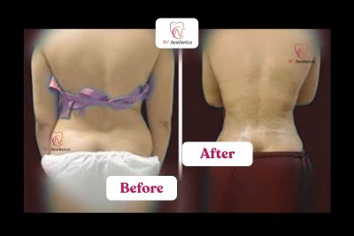 High definition liposuction before and after, abdomen case 1