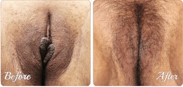 Vaginoplasty in Jaipur