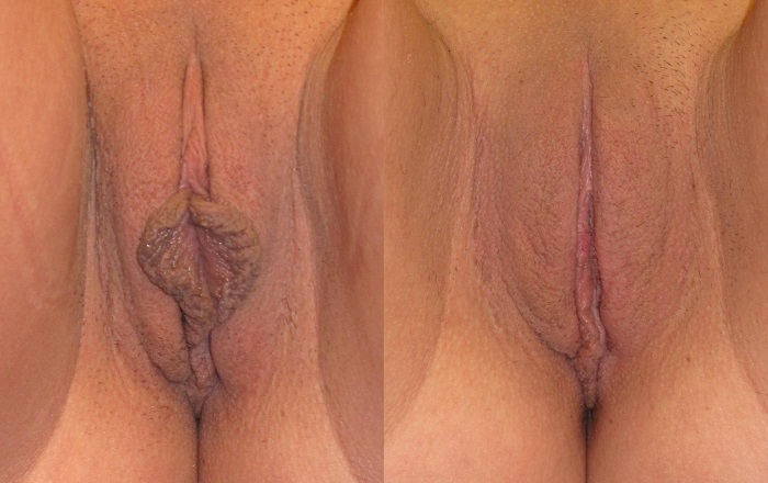 Vaginoplasty in Jaipur